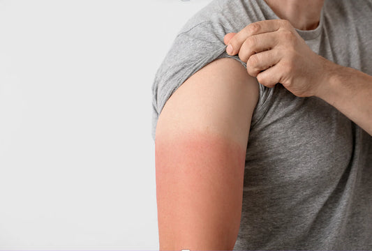 Lipico SCエッセンスは日焼け後にも大活躍！ 潤いで優しく助けてくれます